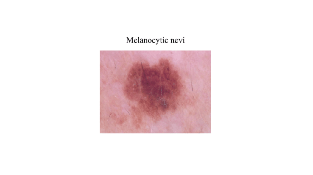 Melanocytic Nevi Classification Using Transfer Learning